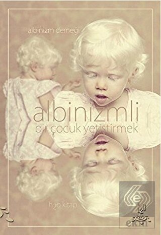 Albinizmli Bir Çocuk Yetiştirmek