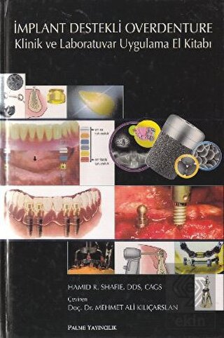 İmplant Destekli Overdenture